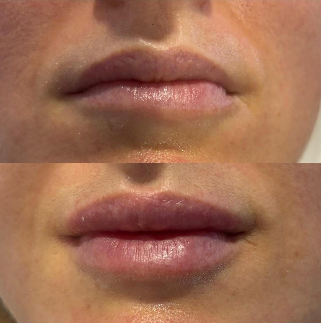 Mesotherapy rezultat 1