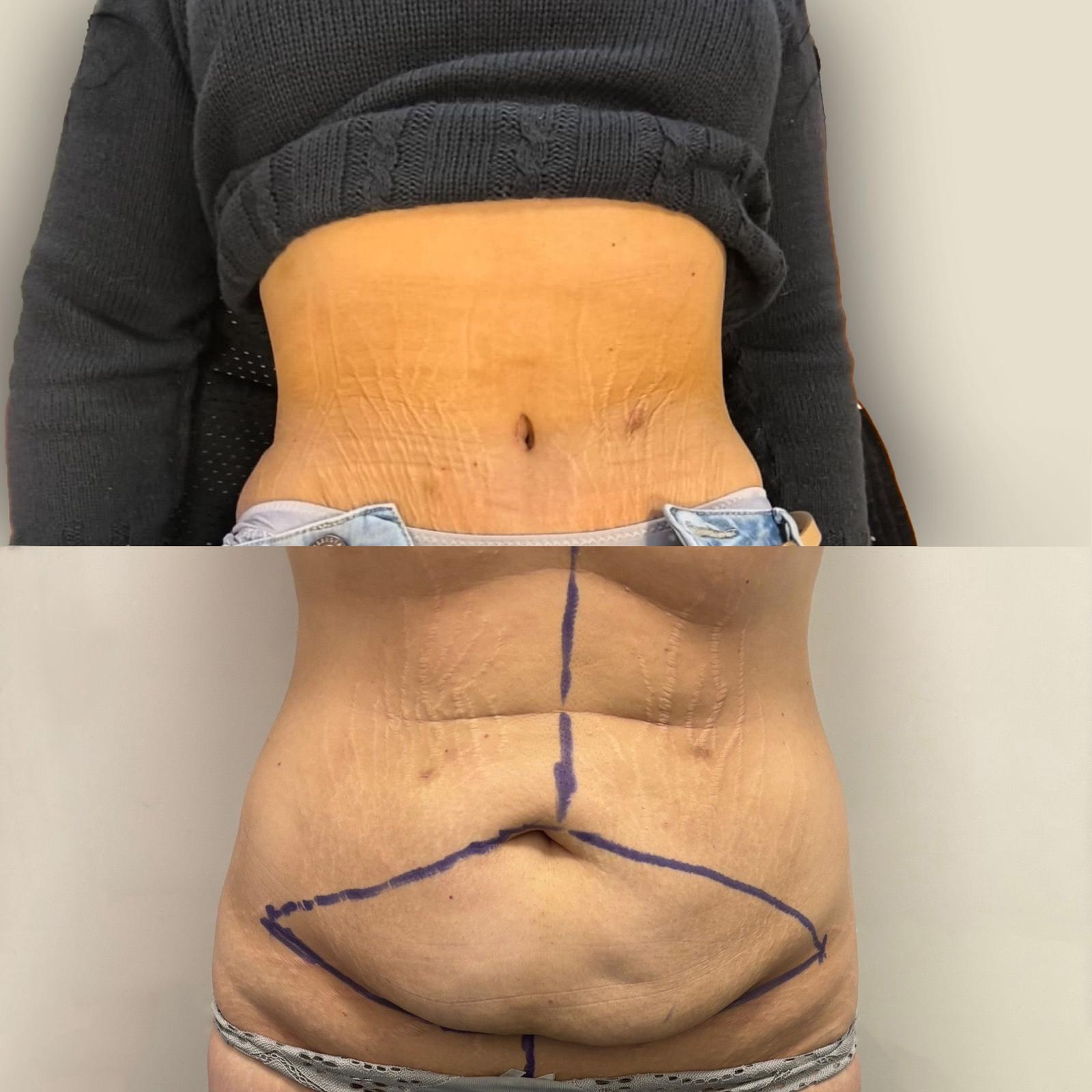 Abdominoplastika rezultat