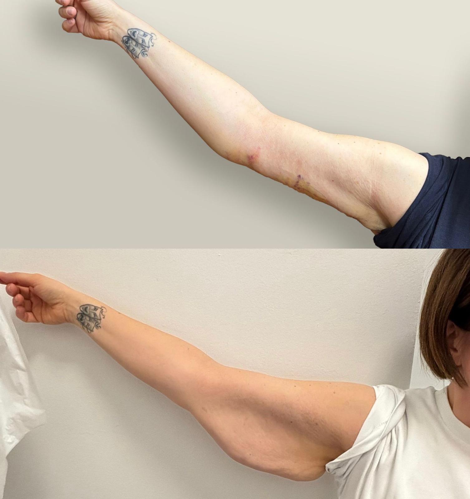 Brachioplasty rezultat